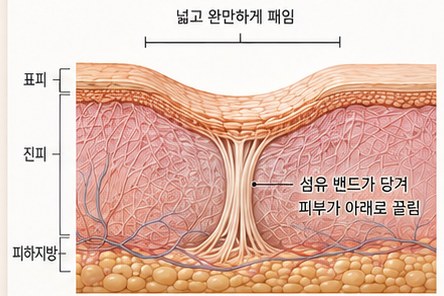 롤링형 흉터