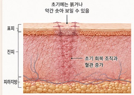선상 흉터